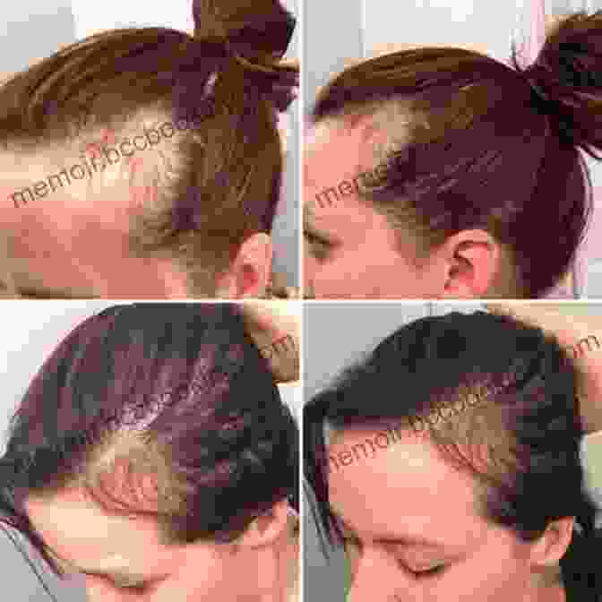A Woman With Hair Loss After Breastfeeding Postpartum Hair Loss: How To Prevent Hair Loss While Breastfeeding (Breastfeeding Problems Post Partum Hairloss Post Pregnancy Weight Loss)